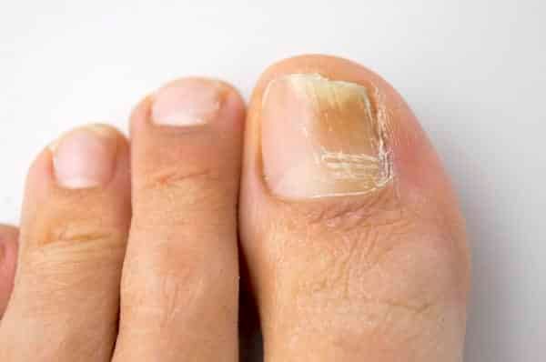 fungal nail infection