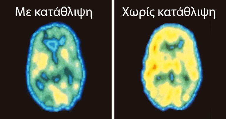 Νέα έρευνα απέδειξε πως η κατάθλιψη δεν είναι επιλογή αλλά μια μορφή εγκεφαλικής βλάβης.
