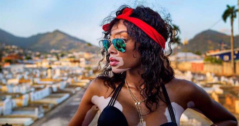 Το μοντέλο με τη λεύκη που «σβήνει» όλα τα τοπ μόντελ