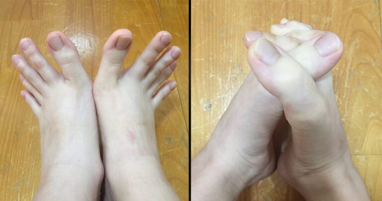 Τα δάχτυλα των ποδιών αυτής της γυναίκας έχουν κυριολεκτικά φρικάρει το διαδίκτυο