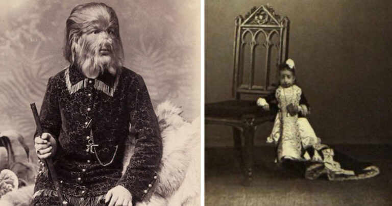 16 γενετικά παραμορφωμένοι ανθρώποι οι οποίοι έγιναν σταρ στο τσίρκο.