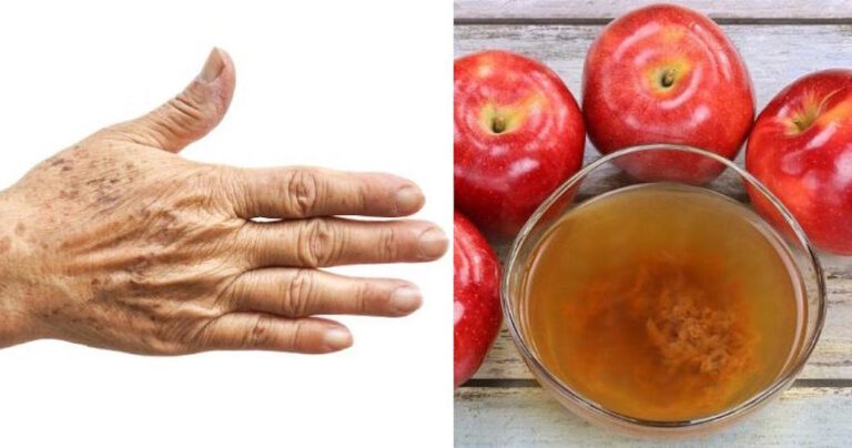 Έτσι μπορείτε να απαλλαγείτε από της μαύρες κηλίδες και τις πανάδες