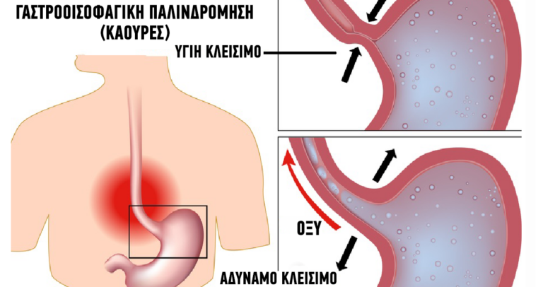 4 ροφήματα που καταπολεμούν αποτελεσματικά τις καούρες.