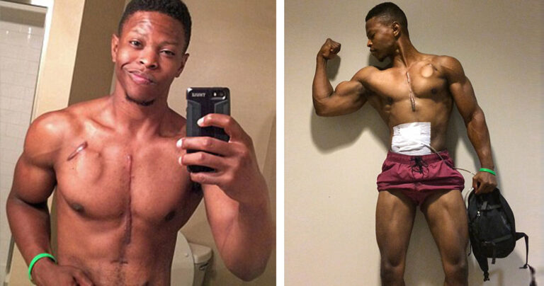 Ο 26χρονος μπόντιμπιλντερ που ζει με την καρδιά σε ένα σακίδιο.