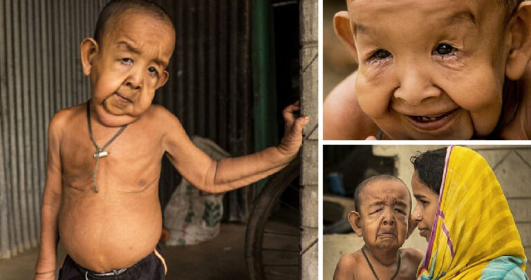 To 4χρονο αγόρι που μοιάζει με γέρο και δεν μπορεί να πάει σχολείο γιατί τα παιδιά τον φοβούνται.