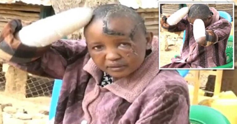 Κενυάτης έκοψε τα χέρια της γυναίκας του επειδή δεν έμενε έγκυος, ενώ το πρόβλημα το είχε εκείνος.