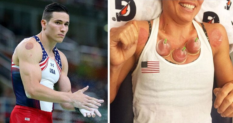 Γιατί οι Αμερικανοί αθλητές στο Ριο έχουν στα κορμιά τους στρογγυλούς κόκκινους μώλωπες;