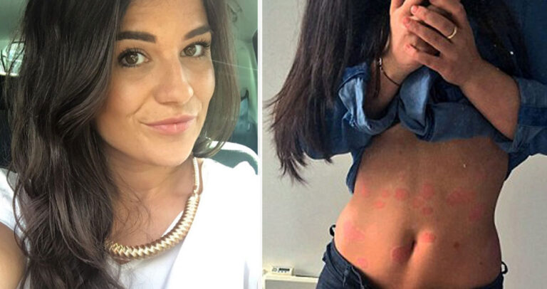 29χρονη με ψωρίαση δείχνει τα σημάδια της και στέλνει το δικό της μήνυμα.