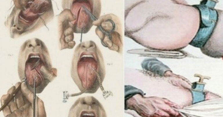 15 χειρουργικά εργαλεία του παρελθόντος που θα σας κάνουν να ανατριχιάσετε.