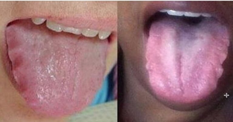 Κοιτάξτε τη γλώσσα σας. Αν εμφανίζεται αυτό, ίσως έχετε πρόβλημα.