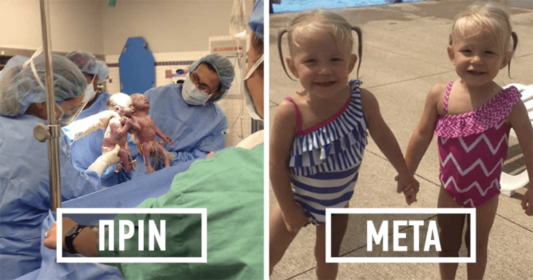 Δίδυμα γεννήθηκαν κρατώντας τα χέρια τους πριν από δυο χρόνια και σήμερα είναι πιο δεμένα από ποτέ.