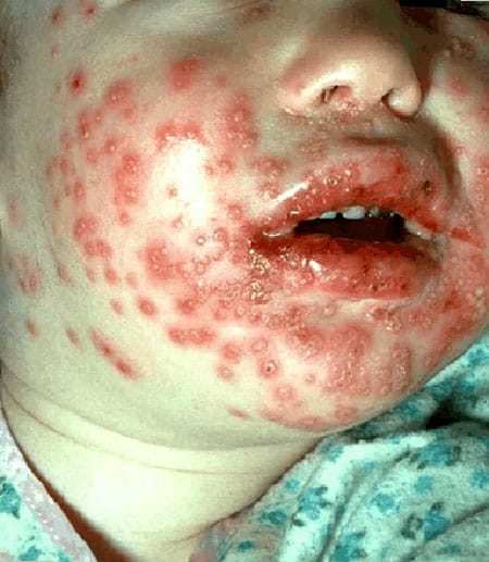Herpes-virus-children