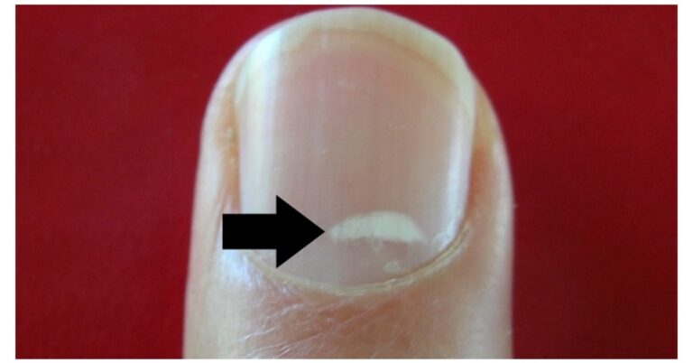 Τελικά, τι είναι αυτά τα λευκά σημάδια στα νύχια μας;