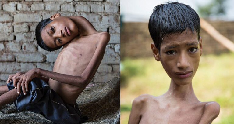 Επέμβαση άλλαξε την ζωή 13χρονου που ζούσε με το κεφάλι κρεμασμένο στο πλάι.