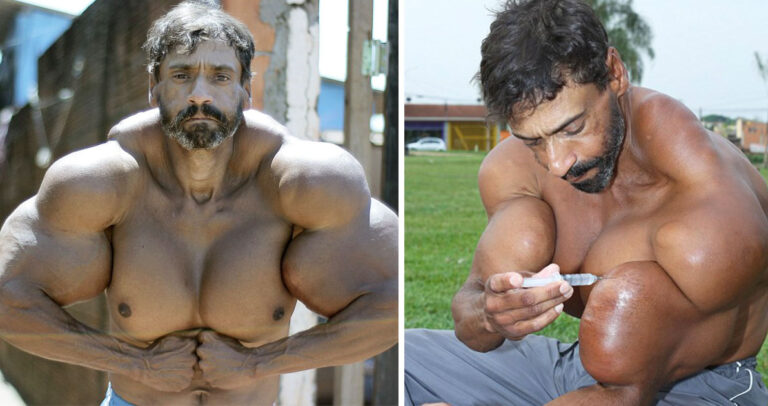 Βραζιλιάνος διπλασίασε εύκολα σε μέγεθος τους μύες του με επικίνδυνες ενέσεις λαδιού.