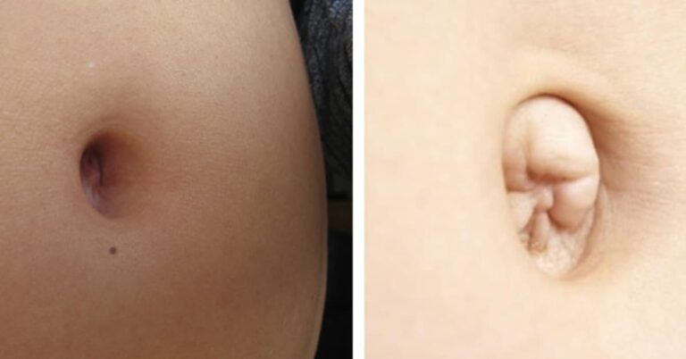 Να γιατί μερικοί άνθρωποι έχουν εξωτερικό αφαλό ενώ οι υπόλοιποι εσωτερικό