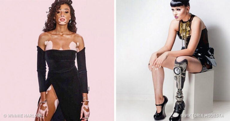 10 διάσημοι που αποδεικνύουν ότι οι σωματικές ατέλειες μας κάνουν πιο δυνατούς