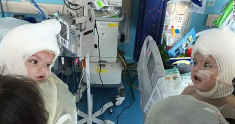 Σιαμαία αδέλφια κοιτάζονται για πρώτη φορά μετά από τον διαχωρισμό τους.