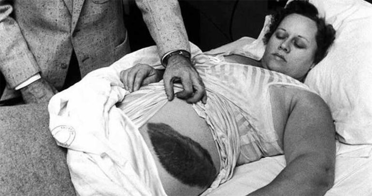 H γυναίκα που χτυπήθηκε από μετεωρίτη ενώ κοιμόταν στον καναπέ της το 1964.