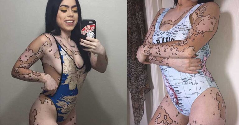 Μετέτρεψε την δερματική της ασθένεια σε τέχνη επειδή την κορόιδευαν όλη της τη ζωή