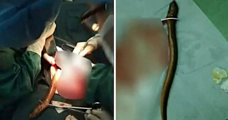 Εργάτης έχωσε χέλι στον πρωκτό του γιατί νόμιζε ότι θα σταματήσει την δυσκοιλιότητα