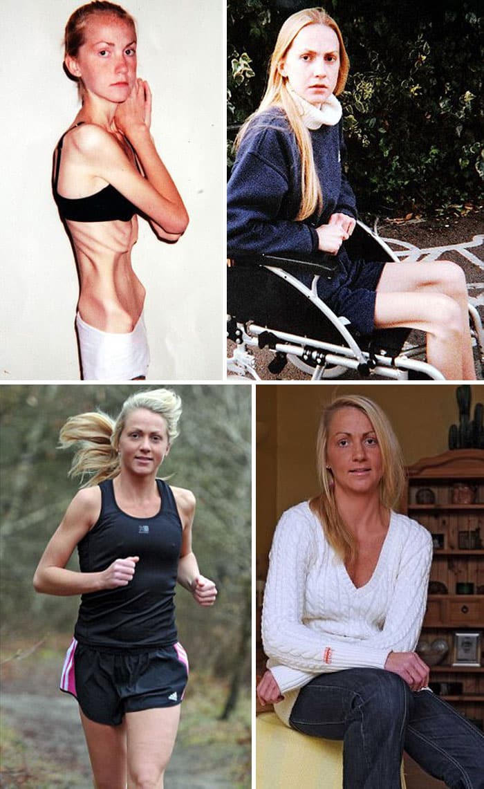 Inspirational Recovery Of Anorexic Nurse Who Was On The Brink Of Death