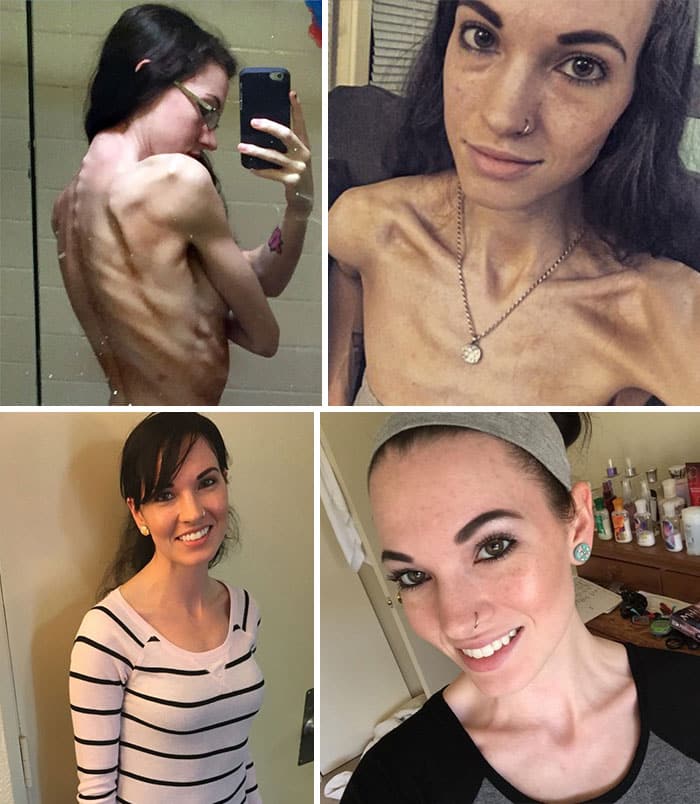Kat Manzullo Developed Anorexia Due To Childhood Bullying But Has Now Finally Hit Healthy Weight