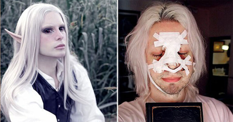 Άντρας ξόδεψε σε πλαστικές 23.000 ευρώ για να μοιάσει σε ξωτικό