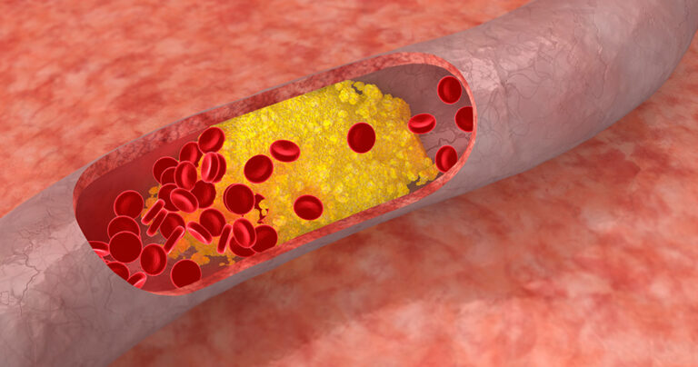 20 τρόφιμα που αποφράσσουν με φυσικό τρόπο τις αρτηρίες