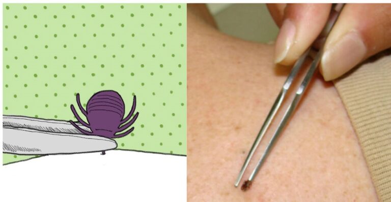 4 πράγματα που δεν πρέπει να κάνετε αν κολλήσει πάνω σας τσιμπούρι