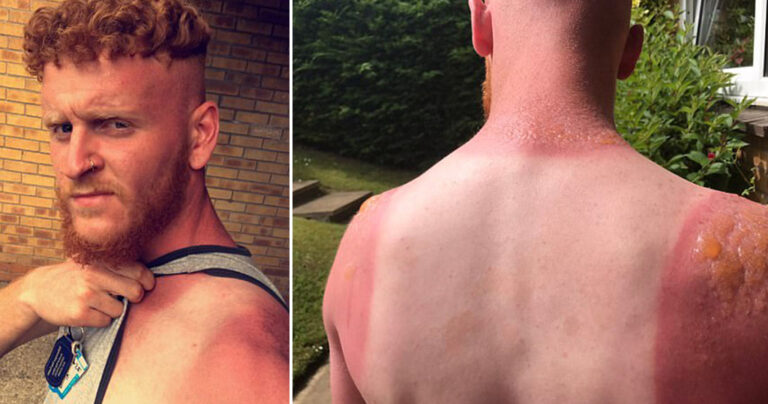 Κηπουρός έπαθε έγκαυμα 2ου βαθμού επειδή δούλεψε σερί 7 ώρες στον ήλιο