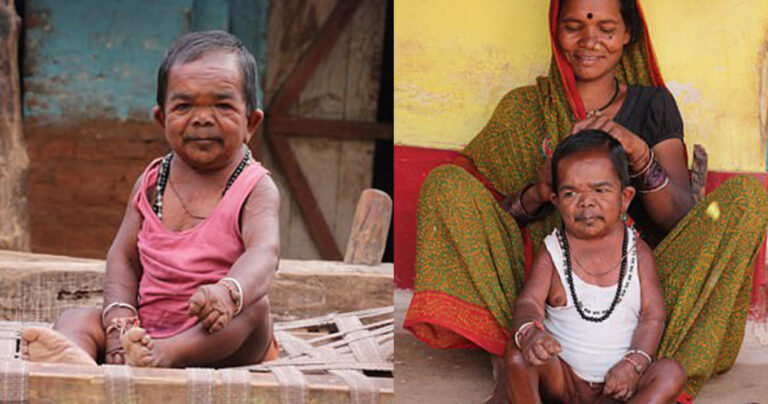 Άνδρας από την Ινδία σταμάτησε να μεγαλώνει από τα 5 του και τώρα είναι διάσημος της περιοχής του