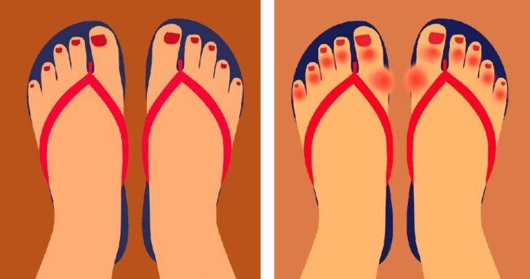 6 λόγοι που οι γιατροί μας προειδοποιούν να μην φοράμε σαγιονάρες