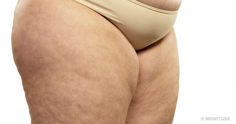 6 αποτελεσματικές ασκήσεις για να απαλλαγείτε από την κυτταρίτιδα άμεσα