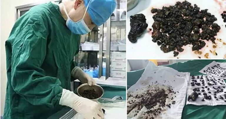 Πάνω από 200 πέτρες στη χολή και το συκώτι βρέθηκαν σε γυναίκα επειδή δεν έτρωγε πρωινό