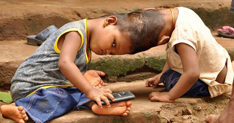 Γονείς με ενωμένα δίδυμα ελπίζουν σύντομα σε μια επέμβαση θαύμα για τα παιδιά τους