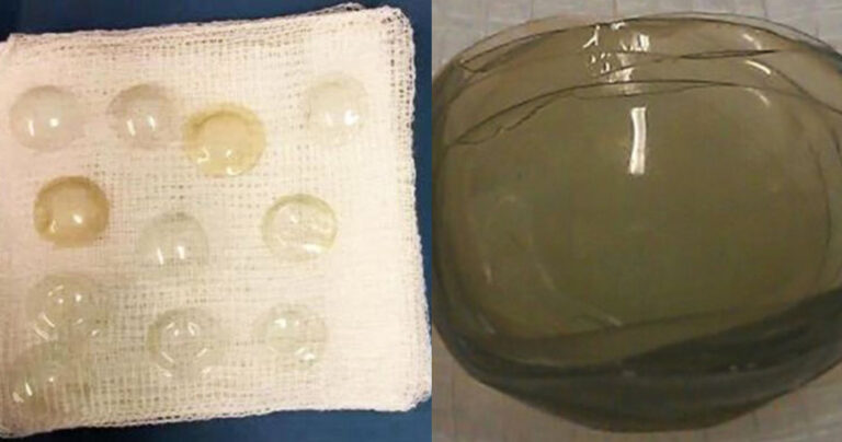 Βρετανίδα είχε ξεχάσει στο μάτι της 27 φακούς επαφής για 35 χρόνια