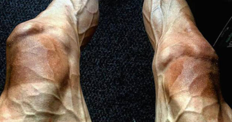 Ποδηλάτης δείχνει τα πόδια του μετά από 16 γύρους στο Ποδηλατικό Γύρο της Γαλλίας