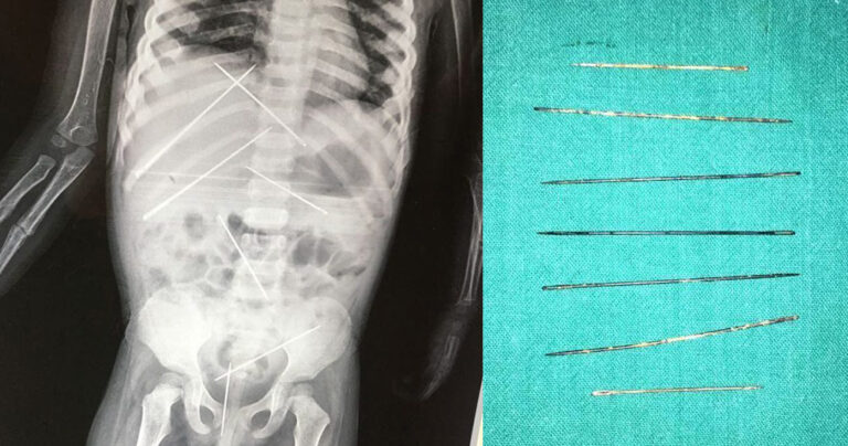 Γεμάτο βελόνες το κορμάκι 3χρονης από μαύρη μαγεία στην Ινδία