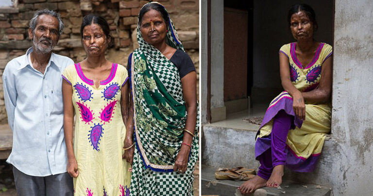 Μητέρα και κόρη συνεχίζουν να ζουν με τον άνδρα που τις παραμόρφωσε με οξύ λόγω φτώχειας