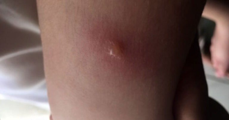 Σε έξαρση ο σταφυλόκοκκος στην Ελλάδα – Τι πρέπει να προσέχουμε