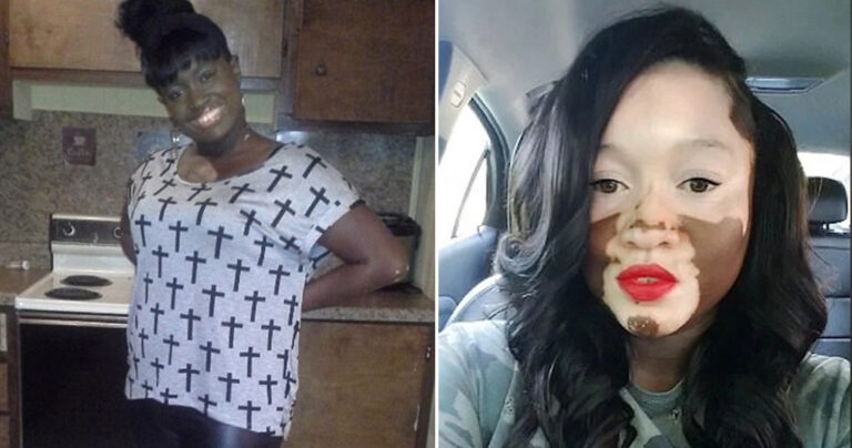 37χρονη με σπάνια δερματική πάθηση μετατρέπεται από μαύρη σε λευκή