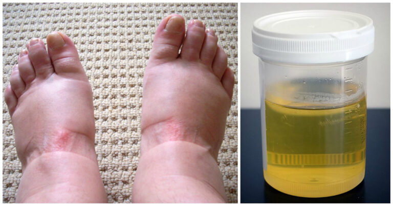 10 συμπτώματα του καρκίνου της ουροδόχου κύστης που κάθε γυναίκα οφείλει να γνωρίζει