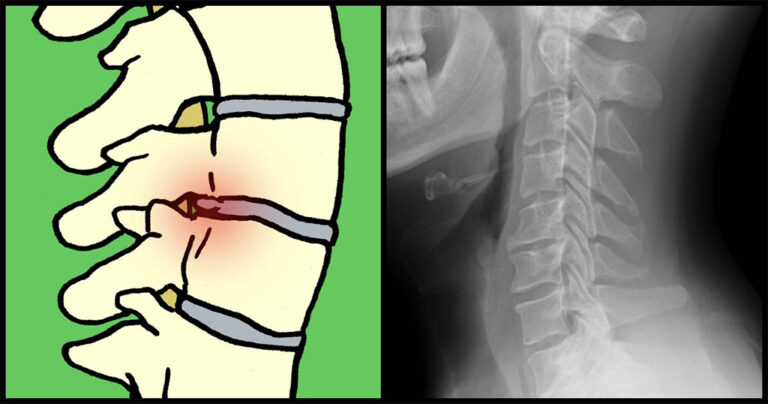 7 σοβαρά σημάδια πόνου στην πλάτη σας που δεν πρέπει ποτέ να αγνοήσετε