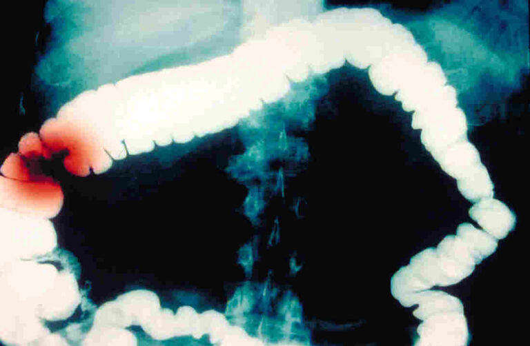 Αυξάνονται οι θάνατοι στους νέους από τον καρκίνο του παχέος εντέρου και κανείς δεν ξέρει το γιατί
