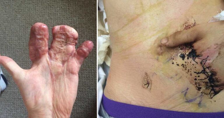 Διαλυμένο χέρι πυροσβέστη σώθηκε όταν οι γιατροί το έραψαν μέσα στην κοιλιά του