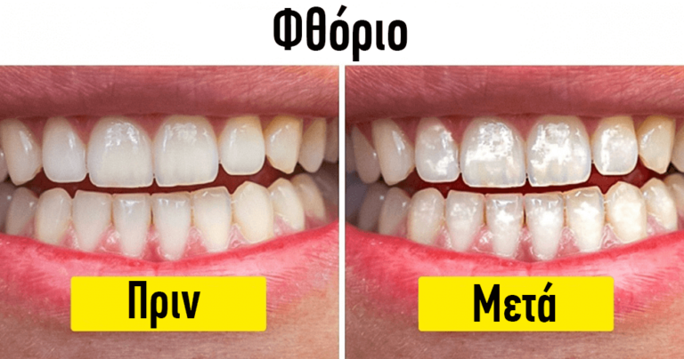 Τα 10 φαγητά και ποτά που βλάπτουν σοβαρά τα δόντια μας
