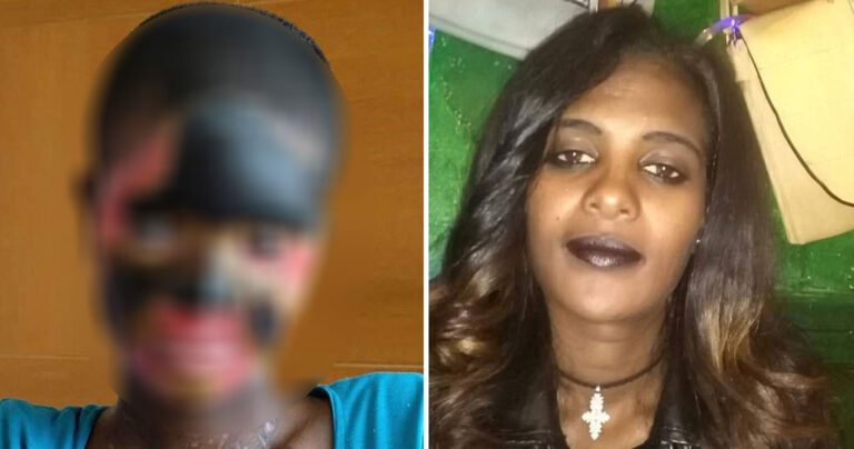 Μητέρα στην Αιθιοπία έχασε την όρασή της και την ομιλία της όταν ο άντρας της την έλουσε με οξύ