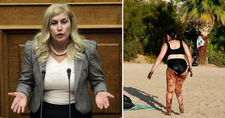 Αυλωνίτου για την γυναίκα με την πίσσα: «Είναι photoshop»