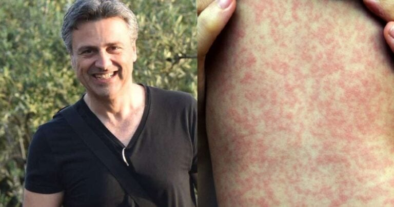 Ο παιδίατρος Α.Δαρζέντας εξηγεί «τι στο καλό γίνεται με την Ιλαρά» και πρέπει να μάθουμε όλοι